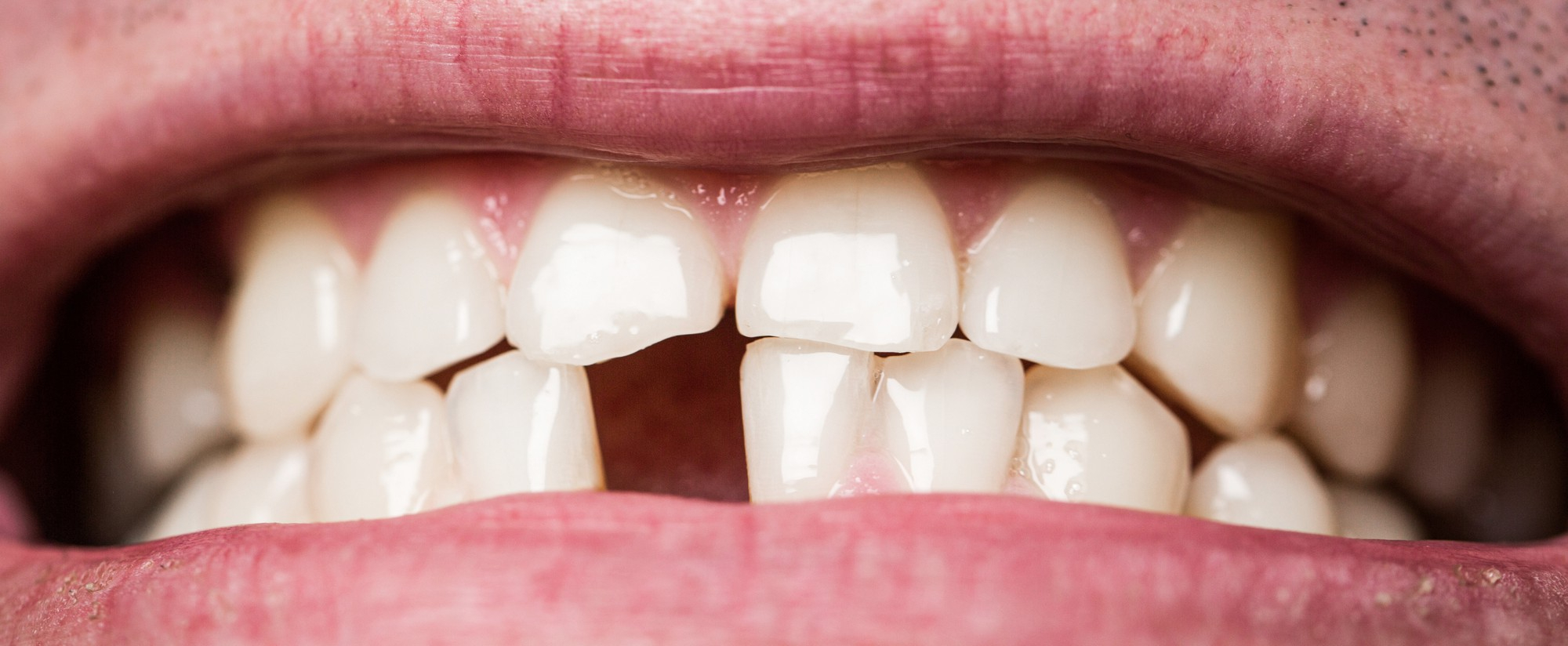 4 Cosas Que Debes Hacer Si Se Te Rompe Un Diente Dental Company